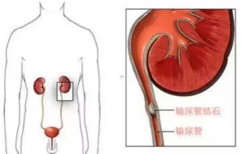 輸尿管結(jié)石，到底能不能保守治療？